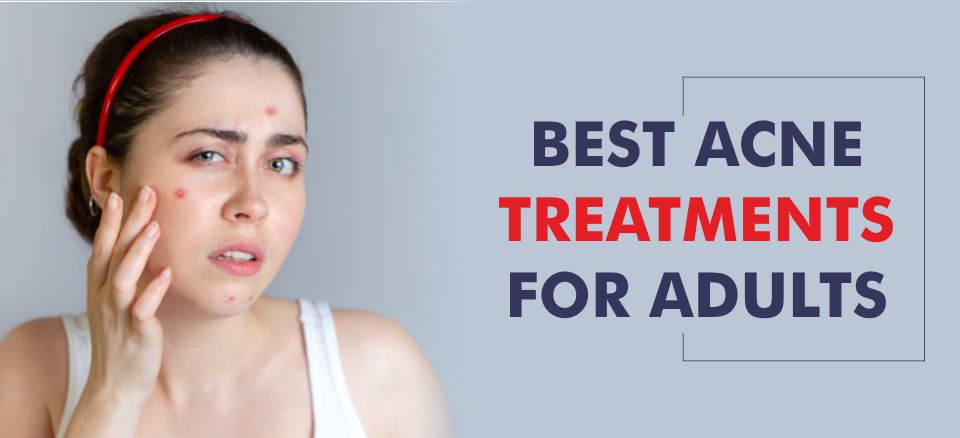 Home Remedies for Acne